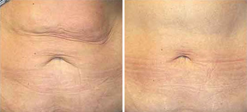 NuEra Treatment Before and After Photos at Cara Mia Medspa in Lake Zurich, IL NuEra Treatment Before and After Photos at Cara Mia Medspa in Lake Zurich, IL