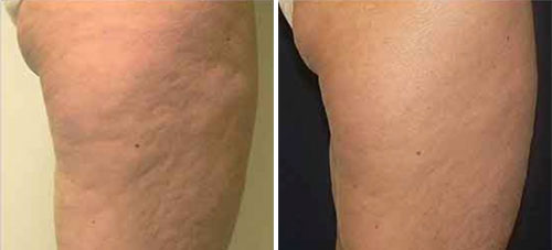 NuEra Treatment Before and After Photos at Cara Mia Medspa in Lake Zurich, IL NuEra Treatment Before and After Photos at Cara Mia Medspa in Lake Zurich, IL