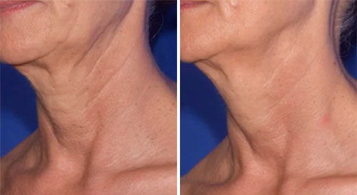 NuEra Treatment Before and After Photos at Cara Mia Medspa in Lake Zurich, IL NuEra Treatment Before and After Photos at Cara Mia Medspa in Lake Zurich, IL