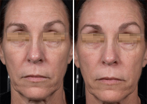 Thermage FLX Treatment Before and After Photos at Cara Mia Medspa in Lake Zurich, IL Thermage FLX Treatment Before and After Photos at Cara Mia Medspa in Lake Zurich, IL