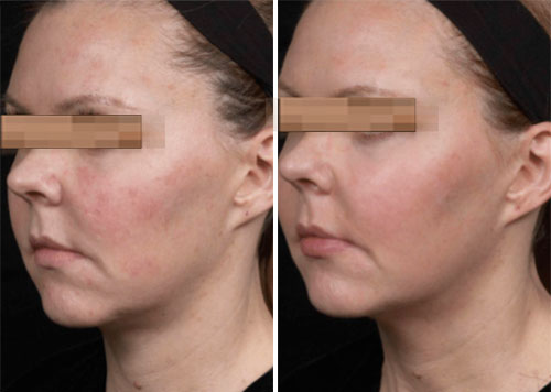 Thermage FLX Treatment Before and After Photos at Cara Mia Medspa in Lake Zurich, IL Thermage FLX Treatment Before and After Photos at Cara Mia Medspa in Lake Zurich, IL