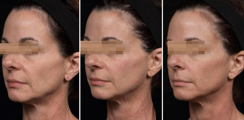 Thermage FLX Treatment Before and After Photos at Cara Mia Medspa in Lake Zurich, IL Thermage FLX Treatment Before and After Photos at Cara Mia Medspa in Lake Zurich, IL