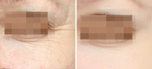 Botox/Jeuveau Treatment Before and After Photos at Cara Mia Medspa in Lake Zurich, IL Botox/Jeuveau Treatment Before and After Photos at Cara Mia Medspa in Lake Zurich, IL