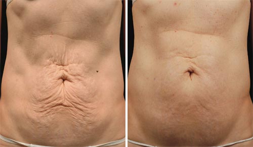 Thermage FLX Treatment Before and After Photos at Cara Mia Medspa in Lake Zurich, IL Thermage FLX Treatment Before and After Photos at Cara Mia Medspa in Lake Zurich, IL