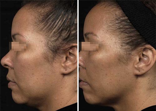 Thermage FLX Treatment Before and After Photos at Cara Mia Medspa in Lake Zurich, IL Thermage FLX Treatment Before and After Photos at Cara Mia Medspa in Lake Zurich, IL