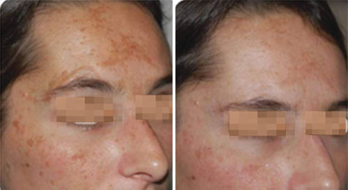 ResurFX Treatment Before and After Photos at Cara Mia Medspa in Lake Zurich, IL ResurFX Treatment Before and After Photos at Cara Mia Medspa in Lake Zurich, IL