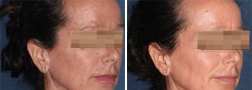 ResurFX Treatment Before and After Photos at Cara Mia Medspa in Lake Zurich, IL ResurFX Treatment Before and After Photos at Cara Mia Medspa in Lake Zurich, IL