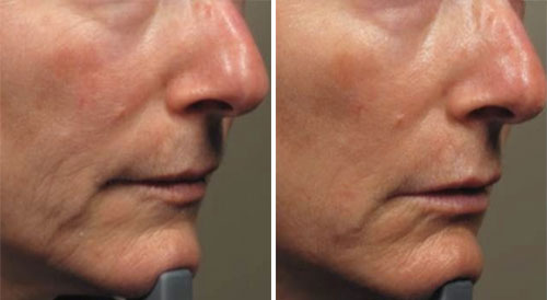 ResurFX Treatment Before and After Photos at Cara Mia Medspa in Lake Zurich, IL ResurFX Treatment Before and After Photos at Cara Mia Medspa in Lake Zurich, IL