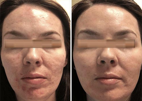 ResurFX Treatment Before and After Photos at Cara Mia Medspa in Lake Zurich, IL ResurFX Treatment Before and After Photos at Cara Mia Medspa in Lake Zurich, IL