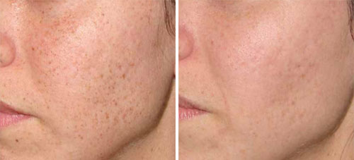 ResurFX Treatment Before and After Photos at Cara Mia Medspa in Lake Zurich, IL ResurFX Treatment Before and After Photos at Cara Mia Medspa in Lake Zurich, IL
