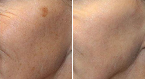 IPL Treatment Before and After Photos at Cara Mia Medspa in Lake Zurich, IL IPL Treatment Before and After Photos at Cara Mia Medspa in Lake Zurich, IL