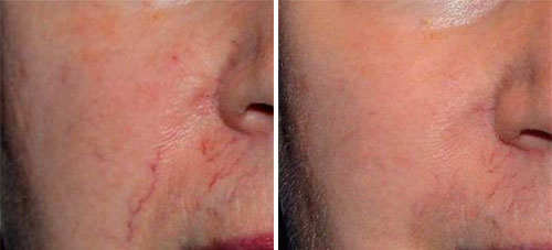 IPL Treatment Before and After Photos at Cara Mia Medspa in Lake Zurich, IL IPL Treatment Before and After Photos at Cara Mia Medspa in Lake Zurich, IL