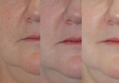 IPL Treatment Before and After Photos at Cara Mia Medspa in Lake Zurich, IL IPL Treatment Before and After Photos at Cara Mia Medspa in Lake Zurich, IL