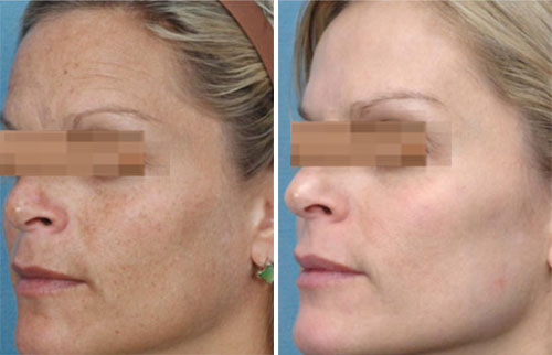 IPL Treatment Before and After Photos at Cara Mia Medspa in Lake Zurich, IL IPL Treatment Before and After Photos at Cara Mia Medspa in Lake Zurich, IL