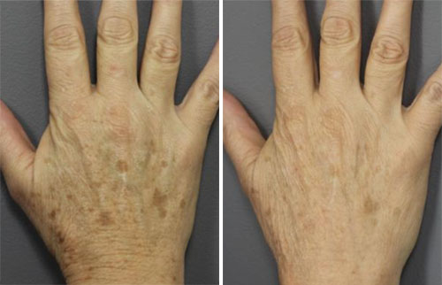 IPL Treatment Before and After Photos at Cara Mia Medspa in Lake Zurich, IL IPL Treatment Before and After Photos at Cara Mia Medspa in Lake Zurich, IL