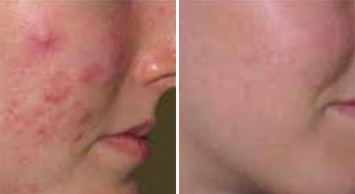 Acne Treatment (IPL)