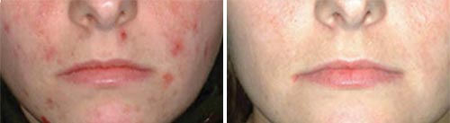 Acne Treatment (IPL) Treatment Before and After Photos at Cara Mia Medspa in Lake Zurich, IL Acne Treatment (IPL) Treatment Before and After Photos at Cara Mia Medspa in Lake Zurich, IL