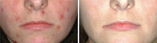 Acne Treatment (IPL)