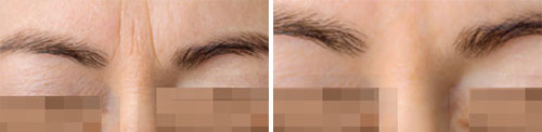 Botox/Jeuveau - Glabella