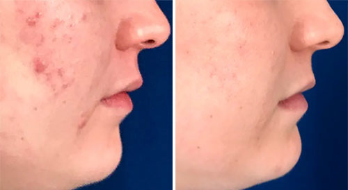 Acne Treatment (IPL) Treatment Before and After Photos at Cara Mia Medspa in Lake Zurich, IL Acne Treatment (IPL) Treatment Before and After Photos at Cara Mia Medspa in Lake Zurich, IL