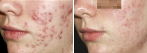 Acne Treatment (IPL) Treatment Before and After Photos at Cara Mia Medspa in Lake Zurich, IL Acne Treatment (IPL) Treatment Before and After Photos at Cara Mia Medspa in Lake Zurich, IL