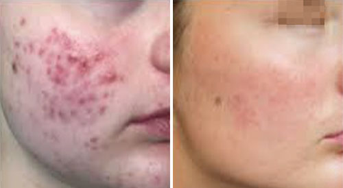 Acne Treatment (IPL) Treatment Before and After Photos at Cara Mia Medspa in Lake Zurich, IL Acne Treatment (IPL) Treatment Before and After Photos at Cara Mia Medspa in Lake Zurich, IL