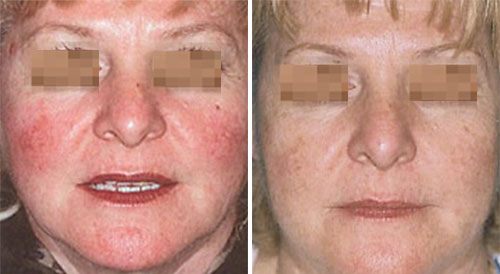 Rosacea Treatment (IPL) Before and After Photos at Cara Mia Medspa in Lake Zurich, IL Rosacea Treatment (IPL) Before and After Photos at Cara Mia Medspa in Lake Zurich, IL