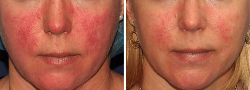 Rosacea Treatment (IPL) Before and After Photos at Cara Mia Medspa in Lake Zurich, IL Rosacea Treatment (IPL) Before and After Photos at Cara Mia Medspa in Lake Zurich, IL