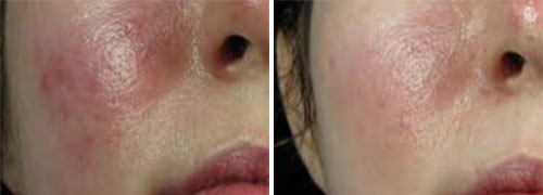 Rosacea Treatment (IPL) Before and After Photos at Cara Mia Medspa in Lake Zurich, IL Rosacea Treatment (IPL) Before and After Photos at Cara Mia Medspa in Lake Zurich, IL