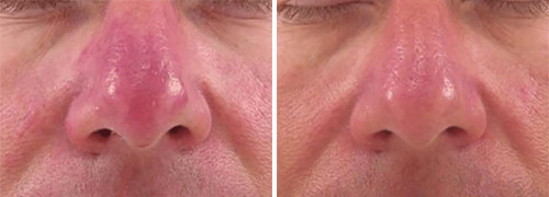 Rosacea Treatment (IPL) Before and After Photos at Cara Mia Medspa in Lake Zurich, IL Rosacea Treatment (IPL) Before and After Photos at Cara Mia Medspa in Lake Zurich, IL