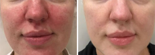 Rosacea Treatment (IPL) Before and After Photos at Cara Mia Medspa in Lake Zurich, IL Rosacea Treatment (IPL) Before and After Photos at Cara Mia Medspa in Lake Zurich, IL