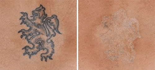 Tattoo Removal Treatment Before and After Photos at Cara Mia Medspa in Lake Zurich, IL Tattoo Removal Treatment Before and After Photos at Cara Mia Medspa in Lake Zurich, IL