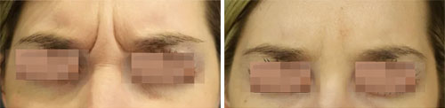 Botox/Jeuveau - Glabella