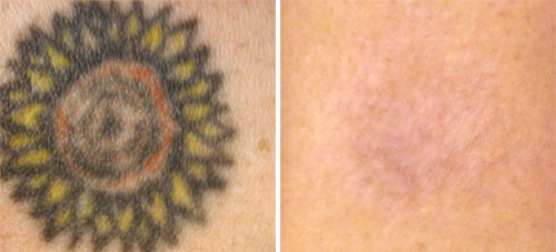 Tattoo Removal Treatment Before and After Photos at Cara Mia Medspa in Lake Zurich, IL Tattoo Removal Treatment Before and After Photos at Cara Mia Medspa in Lake Zurich, IL