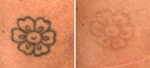 Tattoo Removal Treatment Before and After Photos at Cara Mia Medspa in Lake Zurich, IL Tattoo Removal Treatment Before and After Photos at Cara Mia Medspa in Lake Zurich, IL