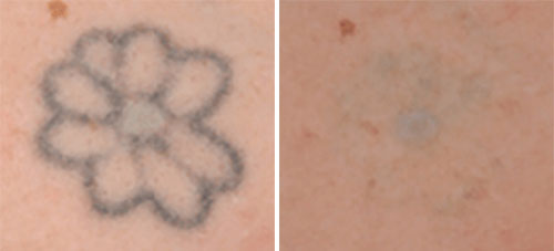 Tattoo Removal Treatment Before and After Photos at Cara Mia Medspa in Lake Zurich, IL Tattoo Removal Treatment Before and After Photos at Cara Mia Medspa in Lake Zurich, IL