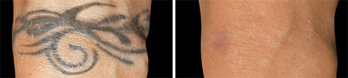 Tattoo Removal Treatment Before and After Photos at Cara Mia Medspa in Lake Zurich, IL Tattoo Removal Treatment Before and After Photos at Cara Mia Medspa in Lake Zurich, IL