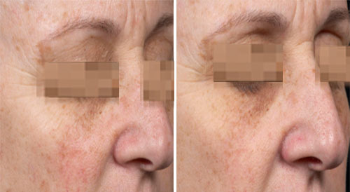 Clear and Brilliant Treatment Before and After Photos at Cara Mia Medspa in Lake Zurich, IL Clear and Brilliant Treatment Before and After Photos at Cara Mia Medspa in Lake Zurich, IL