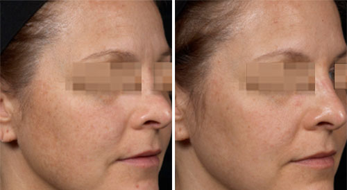 Clear and Brilliant Treatment Before and After Photos at Cara Mia Medspa in Lake Zurich, IL Clear and Brilliant Treatment Before and After Photos at Cara Mia Medspa in Lake Zurich, IL