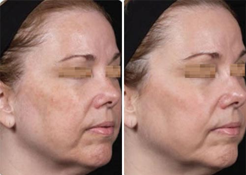 C & B Permea Treatment Before and After Photos at Cara Mia Medspa in Lake Zurich, IL C & B Permea Treatment Before and After Photos at Cara Mia Medspa in Lake Zurich, IL