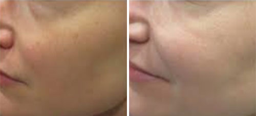 C & B Permea Treatment Before and After Photos at Cara Mia Medspa in Lake Zurich, IL C & B Permea Treatment Before and After Photos at Cara Mia Medspa in Lake Zurich, IL
