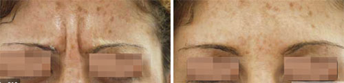 Botox/Jeuveau - Glabella