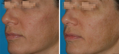 C & B Permea Treatment Before and After Photos at Cara Mia Medspa in Lake Zurich, IL C & B Permea Treatment Before and After Photos at Cara Mia Medspa in Lake Zurich, IL