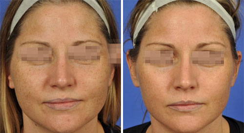 C & B Permea Treatment Before and After Photos at Cara Mia Medspa in Lake Zurich, IL C & B Permea Treatment Before and After Photos at Cara Mia Medspa in Lake Zurich, IL