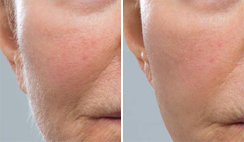 Dermaplaning Treatment Before and After Photos at Cara Mia Medspa in Lake Zurich, IL Dermaplaning Treatment Before and After Photos at Cara Mia Medspa in Lake Zurich, IL