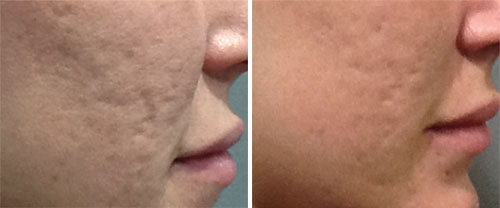 Microneedling