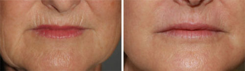 Microneedling Treatment Before and After Photos at Cara Mia Medspa in Lake Zurich, IL Microneedling Treatment Before and After Photos at Cara Mia Medspa in Lake Zurich, IL