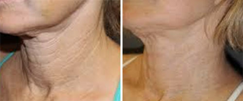 Microneedling Treatment Before and After Photos at Cara Mia Medspa in Lake Zurich, IL Microneedling Treatment Before and After Photos at Cara Mia Medspa in Lake Zurich, IL