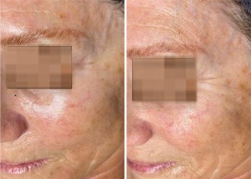 Oxygeneo Facial Before and After Photos at Cara Mia Medspa in Lake Zurich, IL Oxygeneo Facial Before and After Photos at Cara Mia Medspa in Lake Zurich, IL