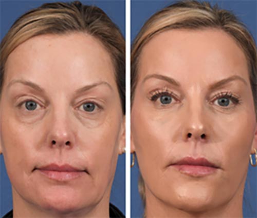 Facial Balancing with Fillers Near Me in Lake Zurich IL